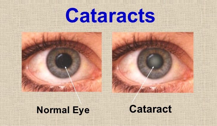 Cataract treatment