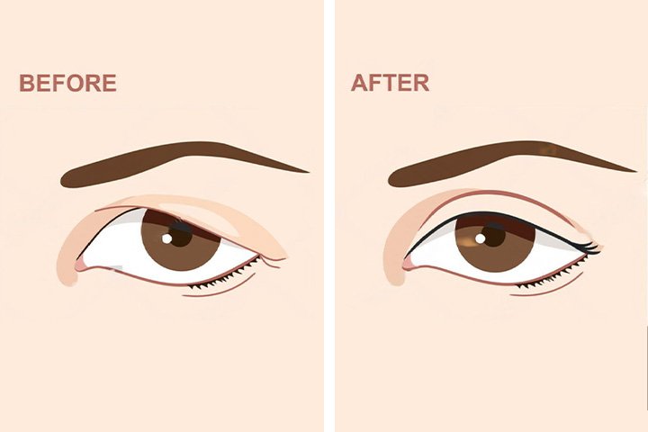 Cataract treatment  