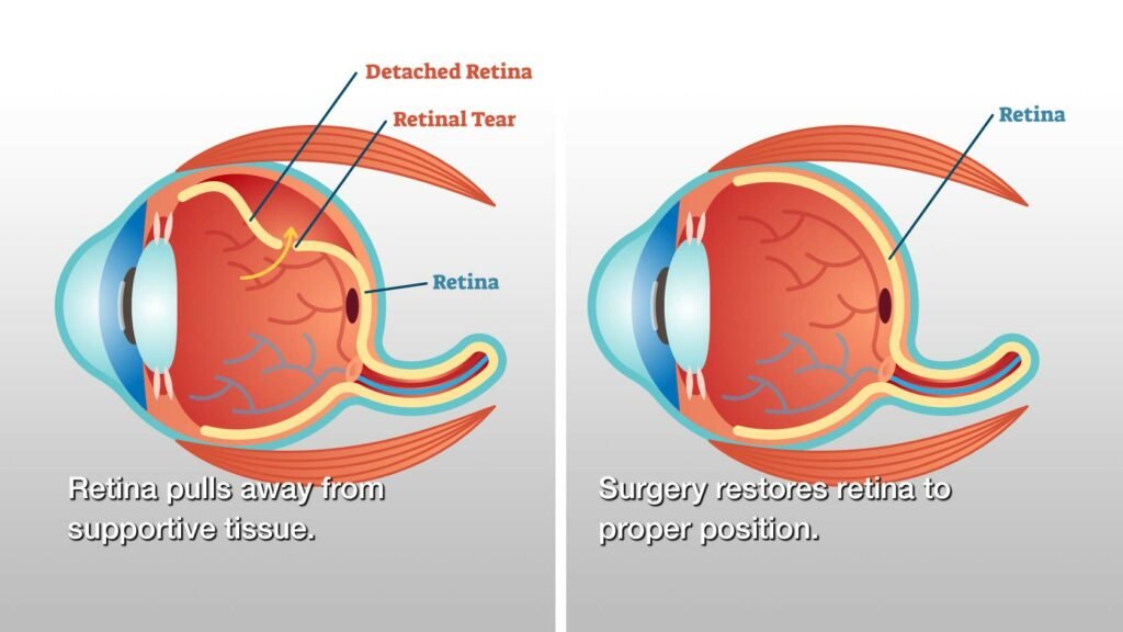 Cataract treatment  