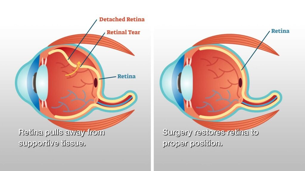 Cataract treatment