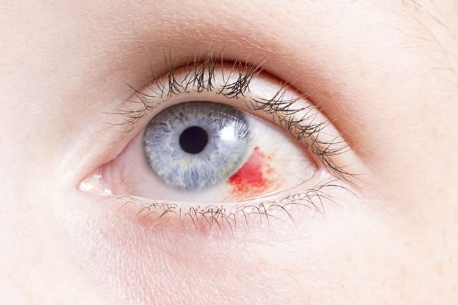 Cataract treatment  